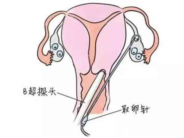 取卵后下月还有没有新卵泡揭秘，和卵巢具体情况有关